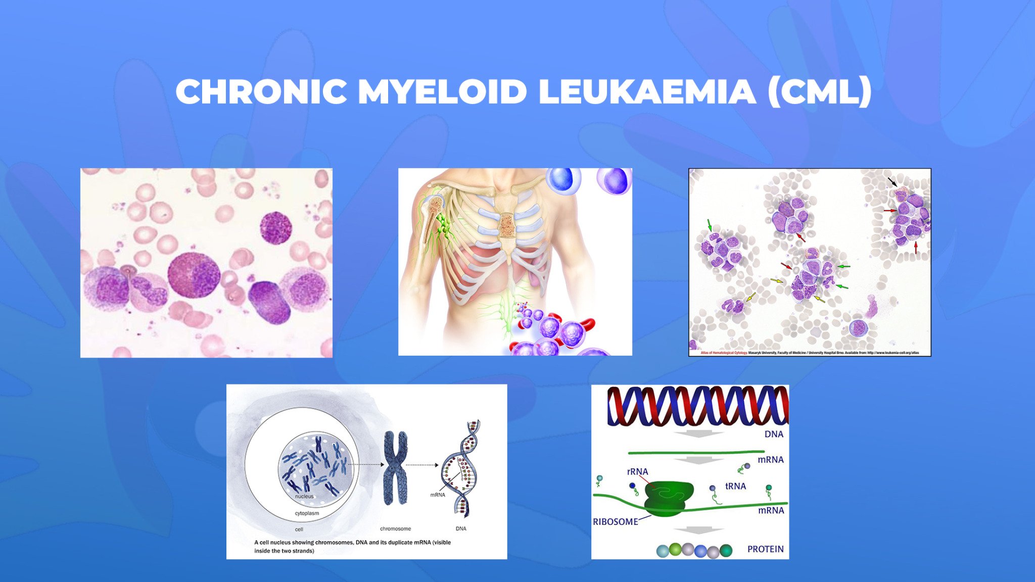25-Chronic-myeloid-leukaemia-CML