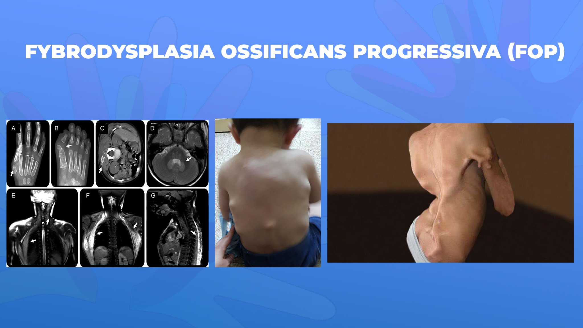 24-Fybrodysplasia-ossificans-progressiva-FOP