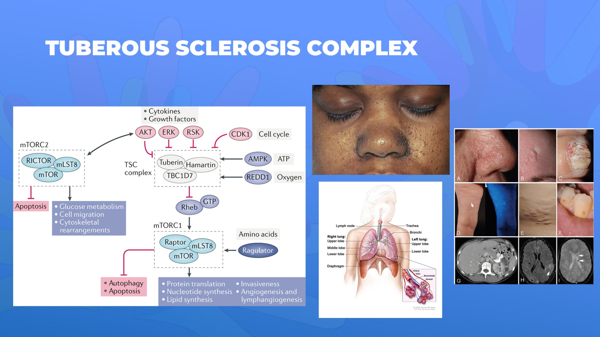 23-Tuberous-sclerosis-complex