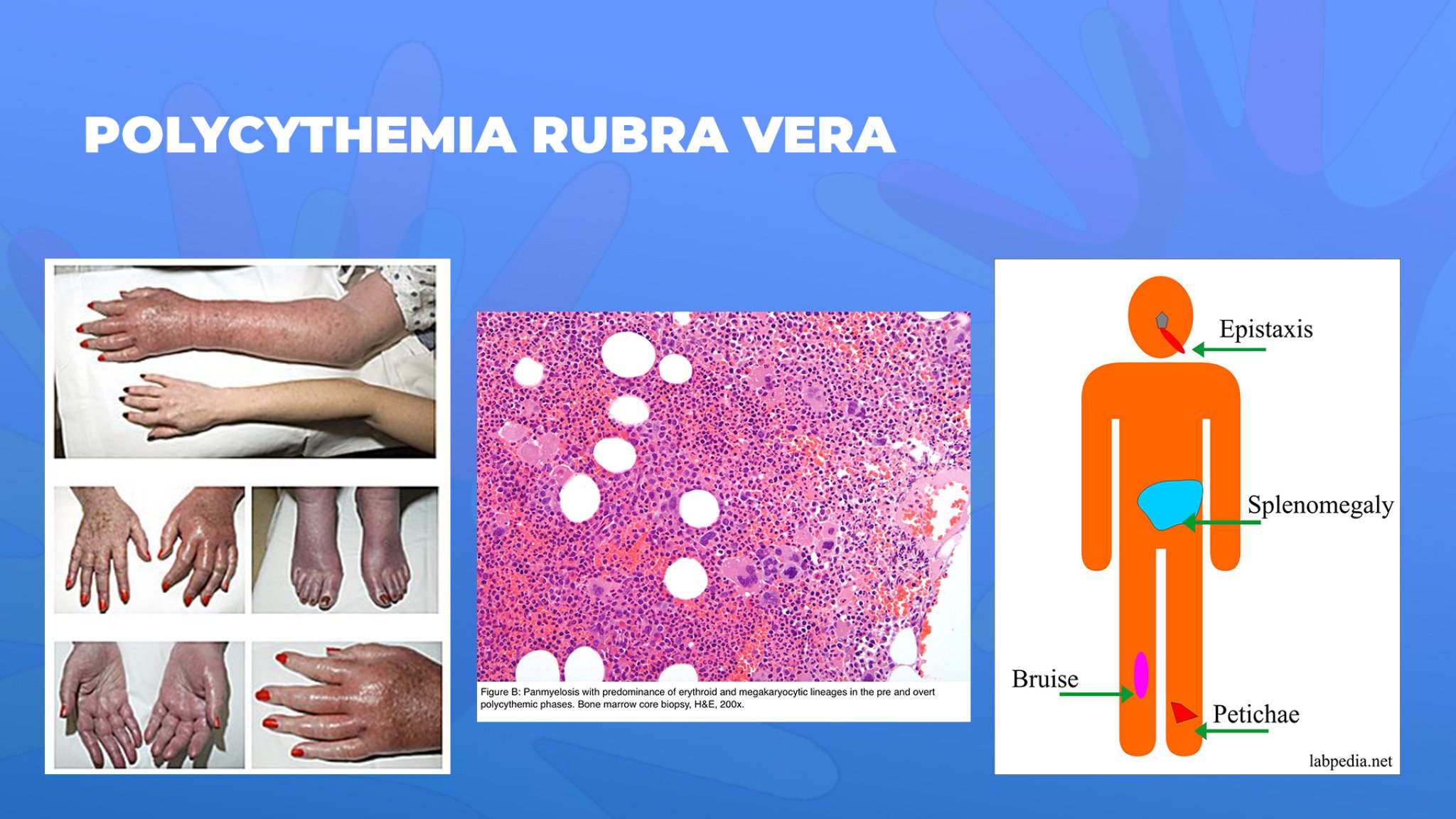 22-Polycythemia-Rubra-Vera