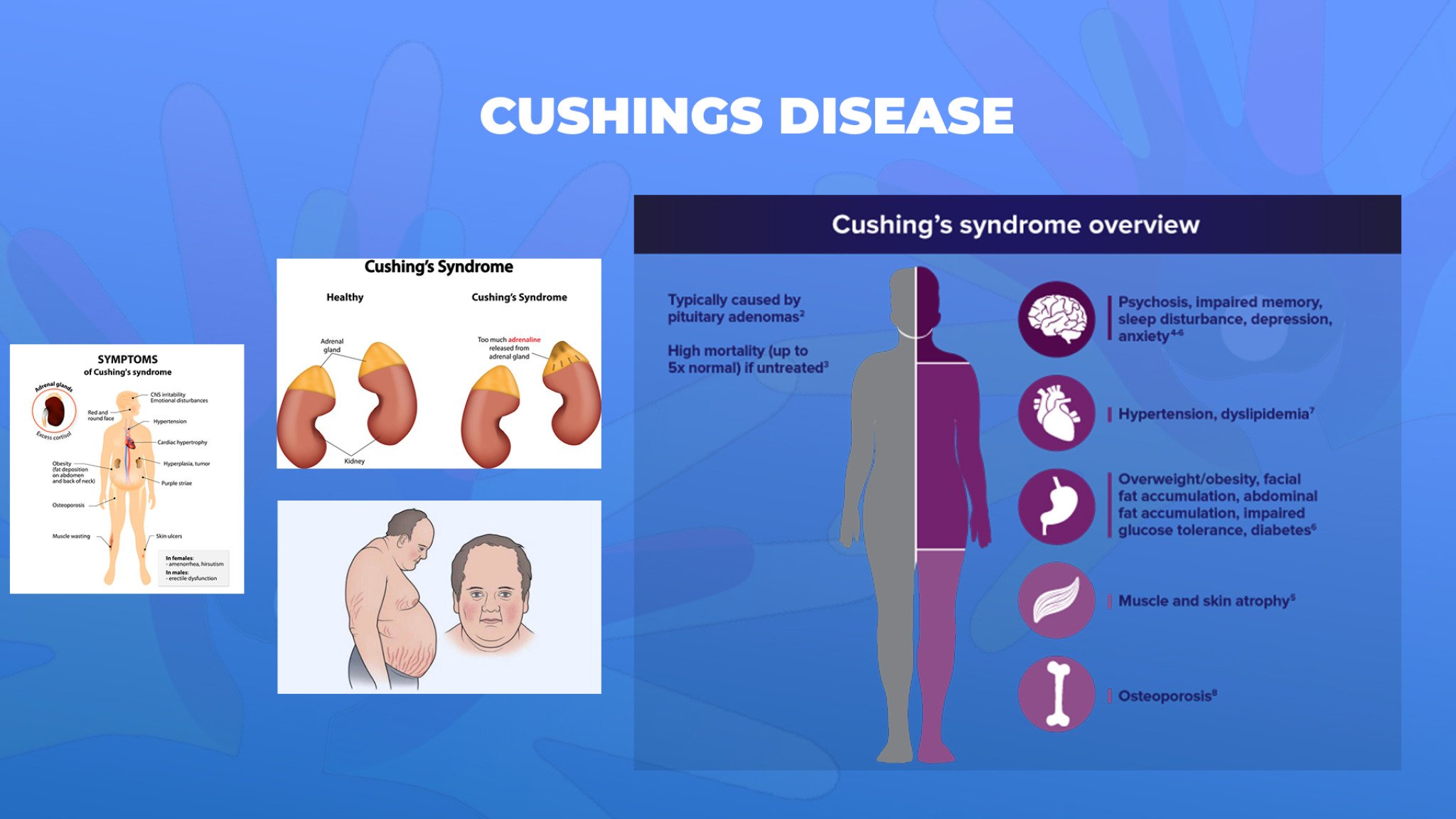 19-Cushings-Disease