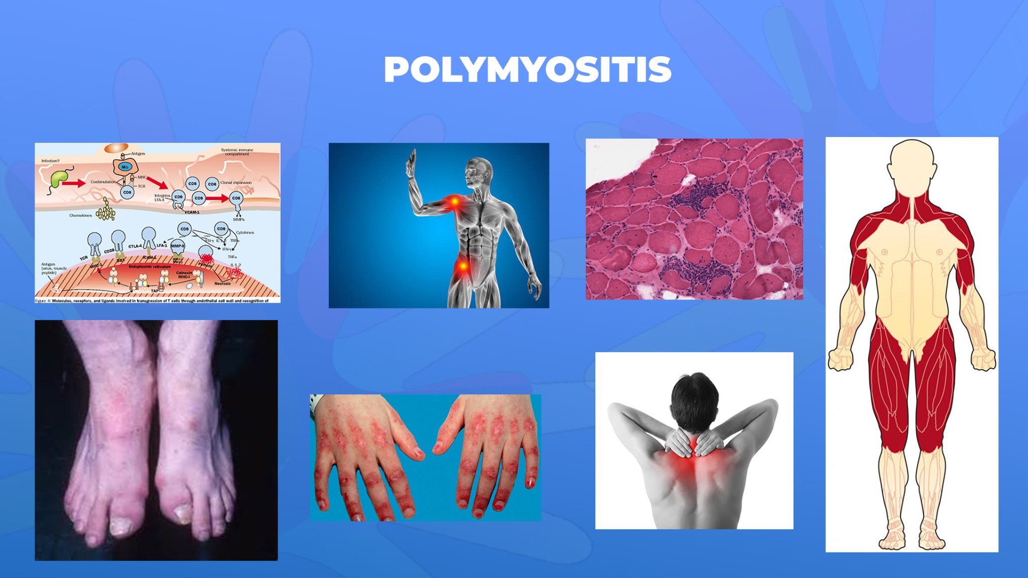 17-Polymyositis
