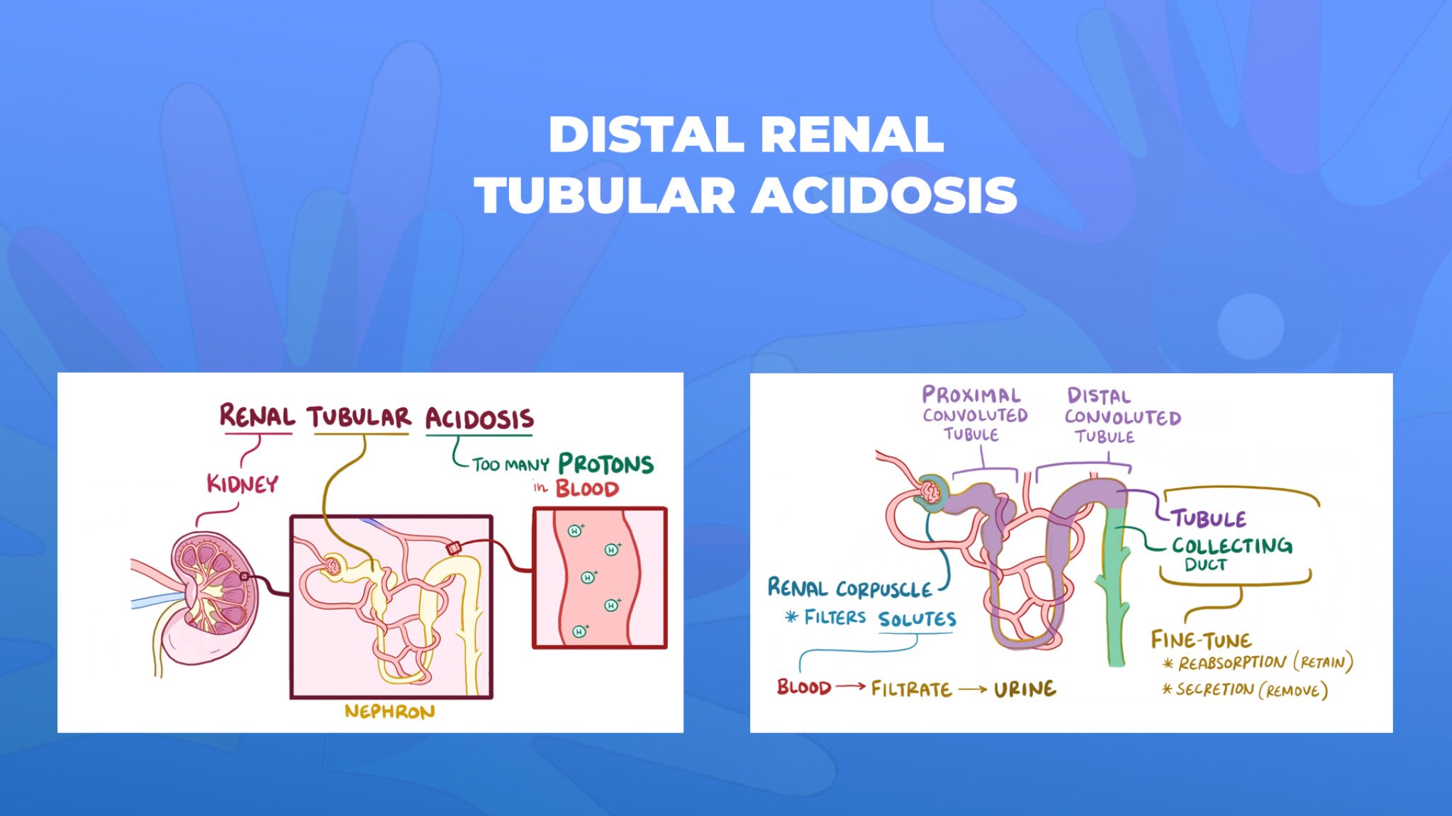 16-Distal-renal-tubular-acidosis