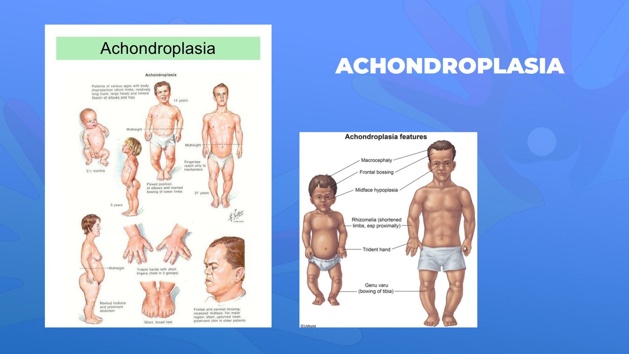 15-Achondroplasia