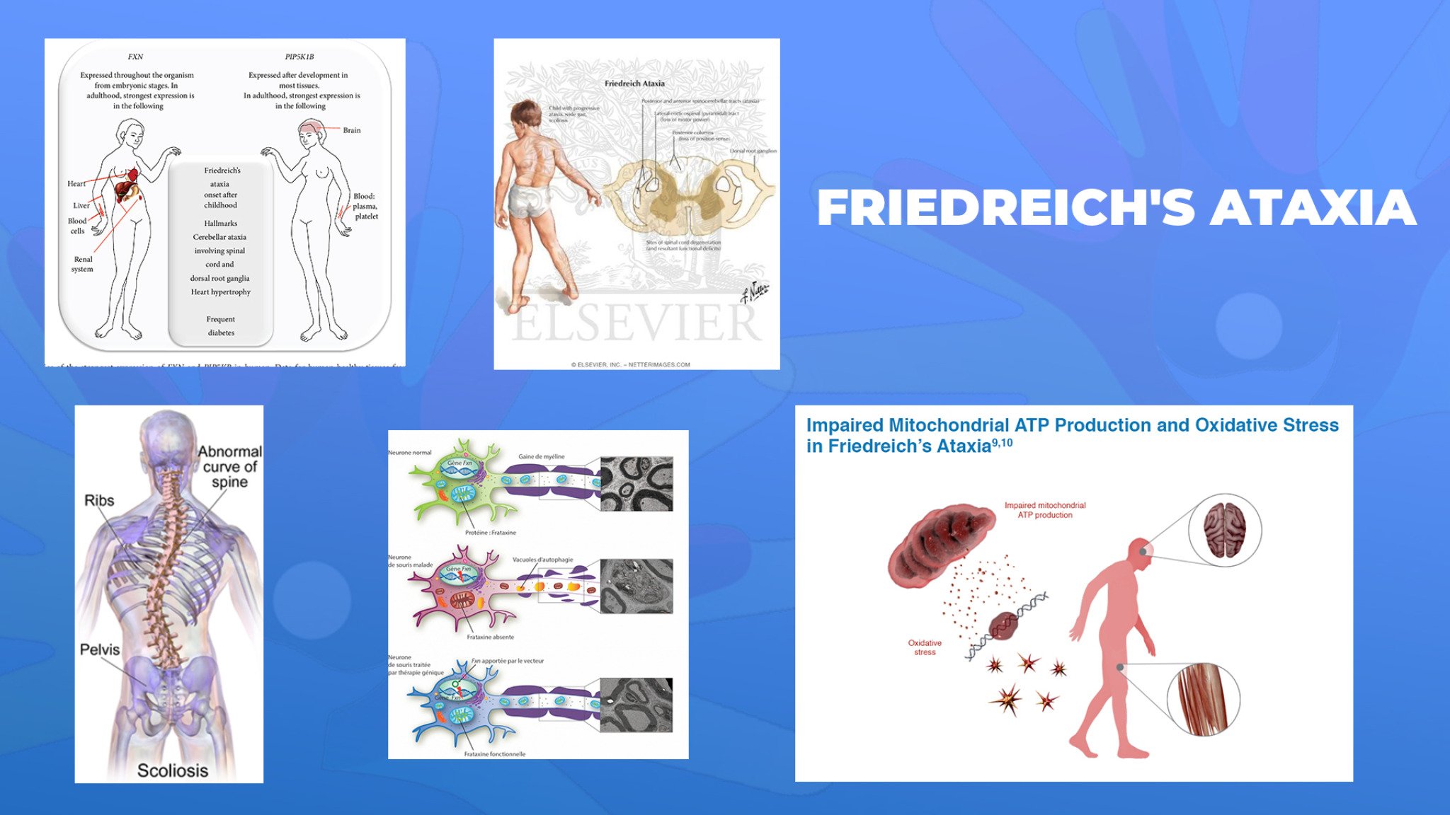 13-Friedreichs-ataxia