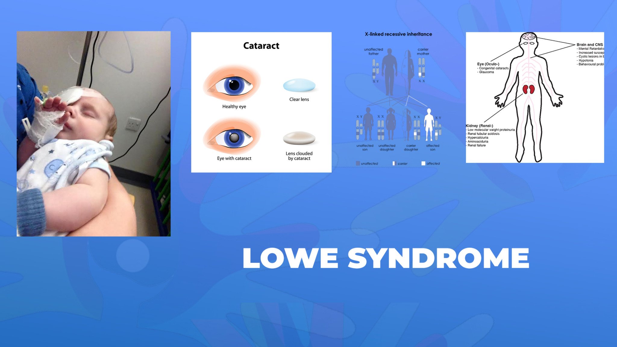 09-Lowe-syndrome