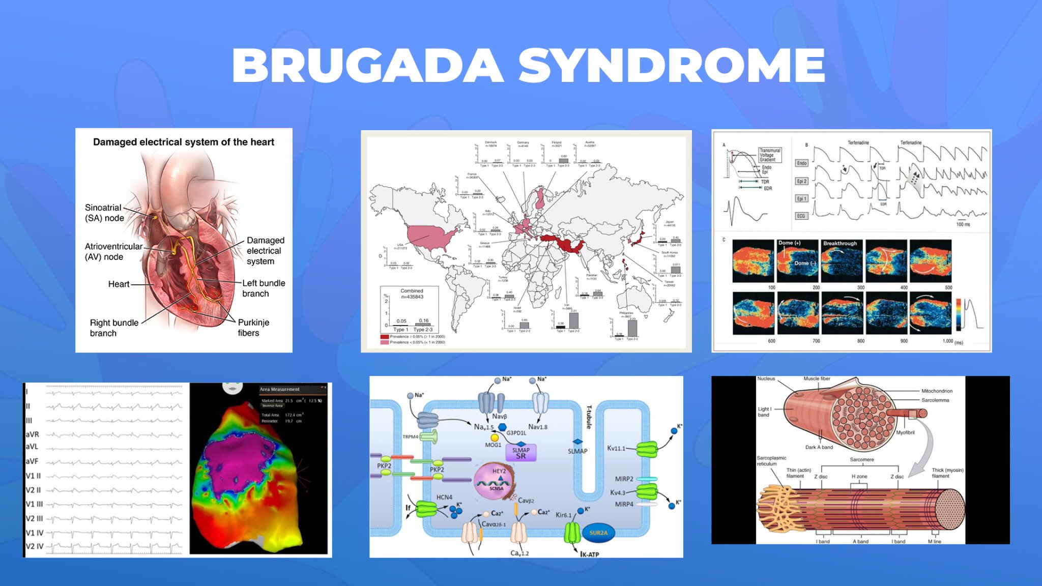 08-Brugada-syndrome