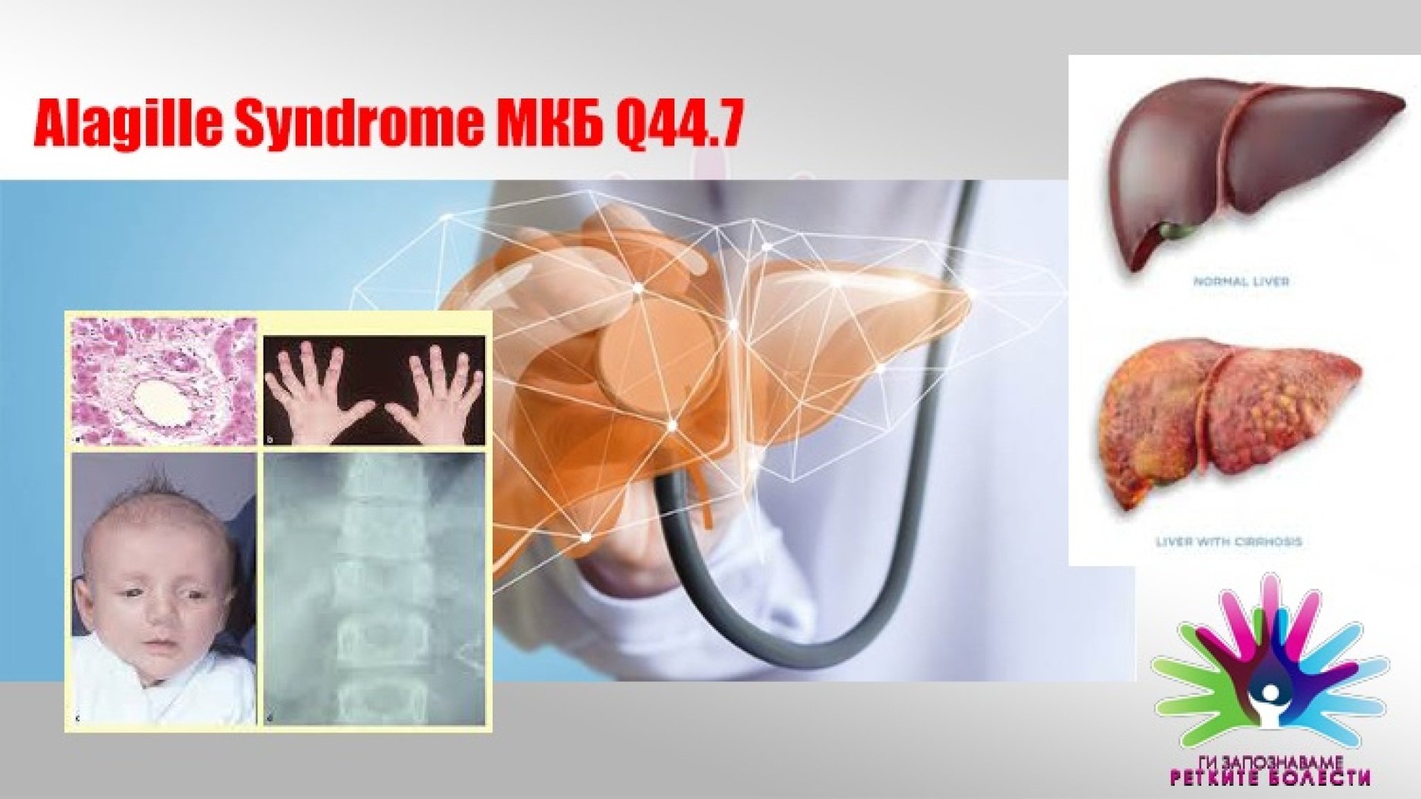 03-Retki-bolesti-Alazil-Sindrom